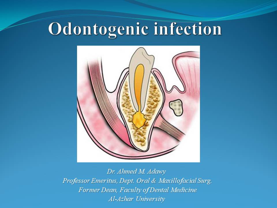 odontogenic infection